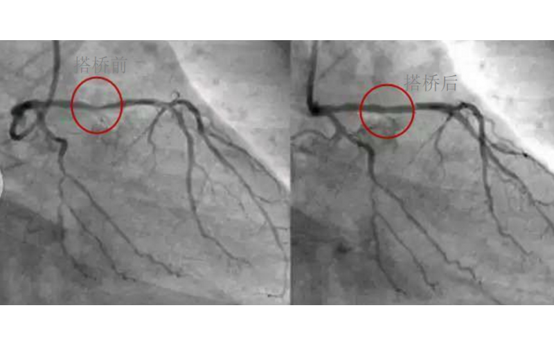 深圳市模具廠對(duì)心臟支架的關(guān)注，國(guó)產(chǎn)化的道路有多長(zhǎng)？